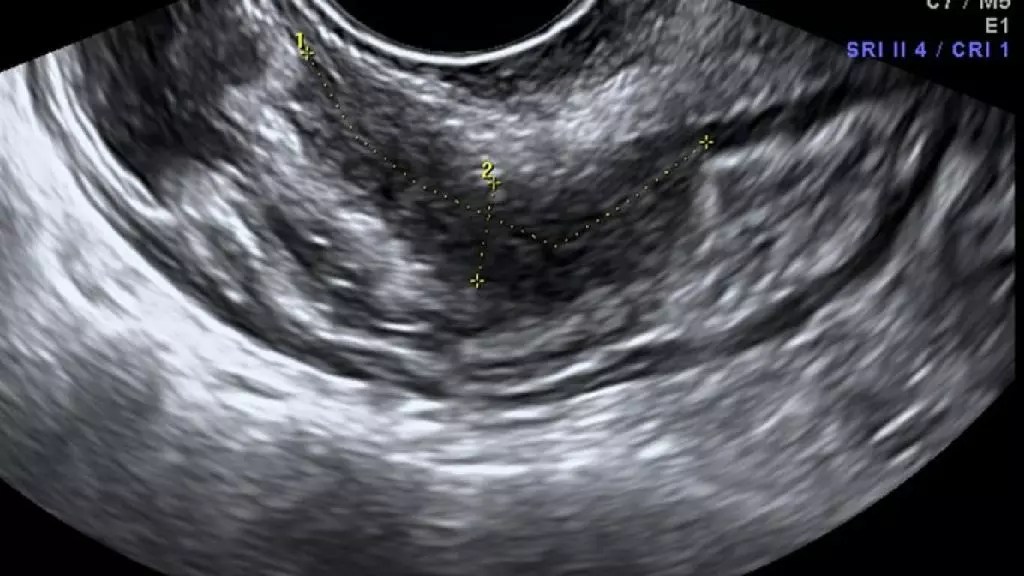 La endometriosis podría ser detectado con un simple análisis de sangre