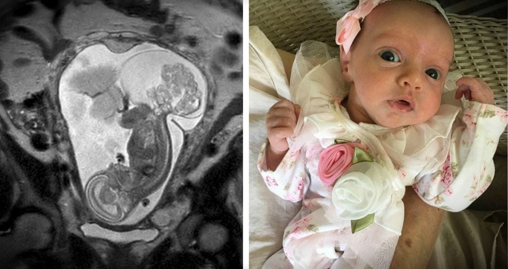 Lynlee, la niña que nació dos veces 1 Lynlee, la niña que nació dos veces