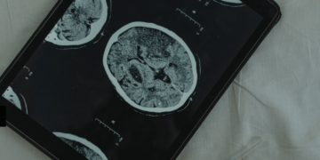 Un implante cerebral que transmite pensamientos en tiempo real
