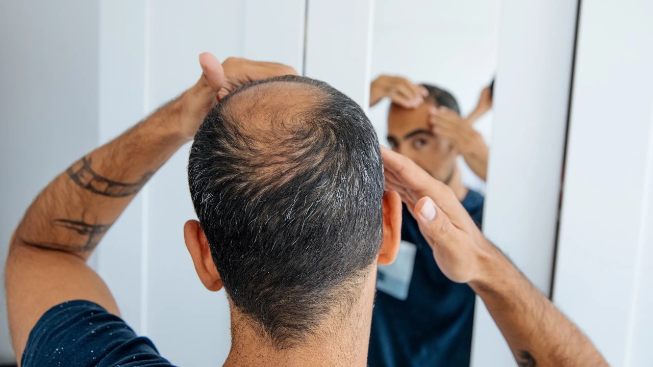 Esperanza contra la calvicie: el azúcar natural estimula el crecimiento del cabello 3 Calvicie masculina: ¿Qué hacer si comienzas a notar la caída del cabello? | GQ