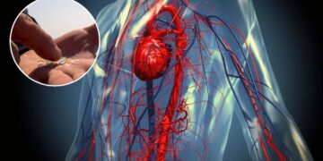 Encuentran microplásticos en las arterias de sobrevivientes de ACV