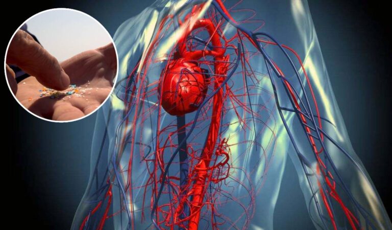 Encuentran microplásticos en las arterias de sobrevivientes de ACV