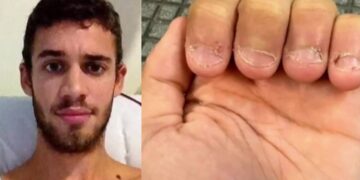 Morderse las uñas casi le cuesta la vida  a un influencer peruano